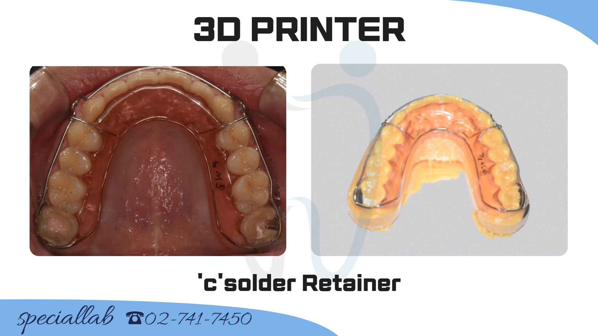 SNU 코골이 장치