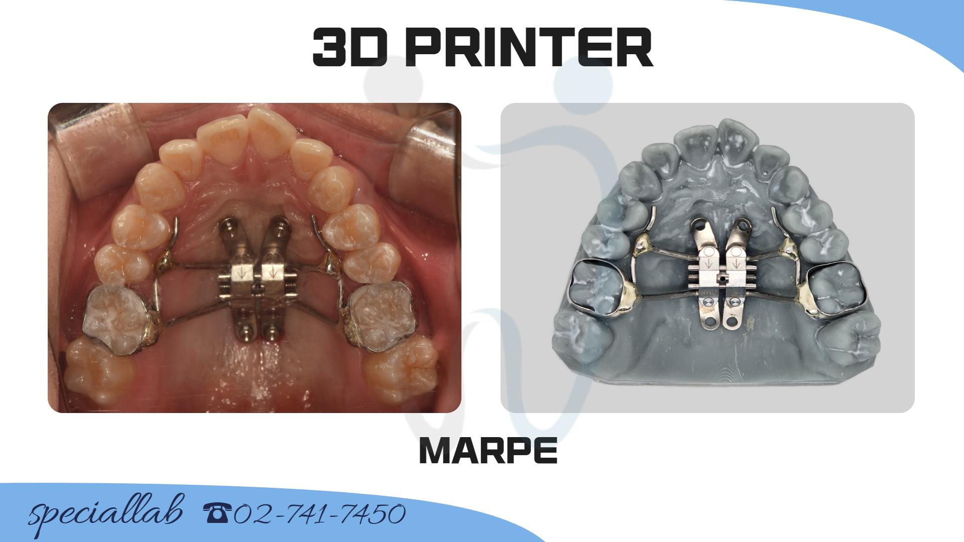 3D CR 스플린트 Before