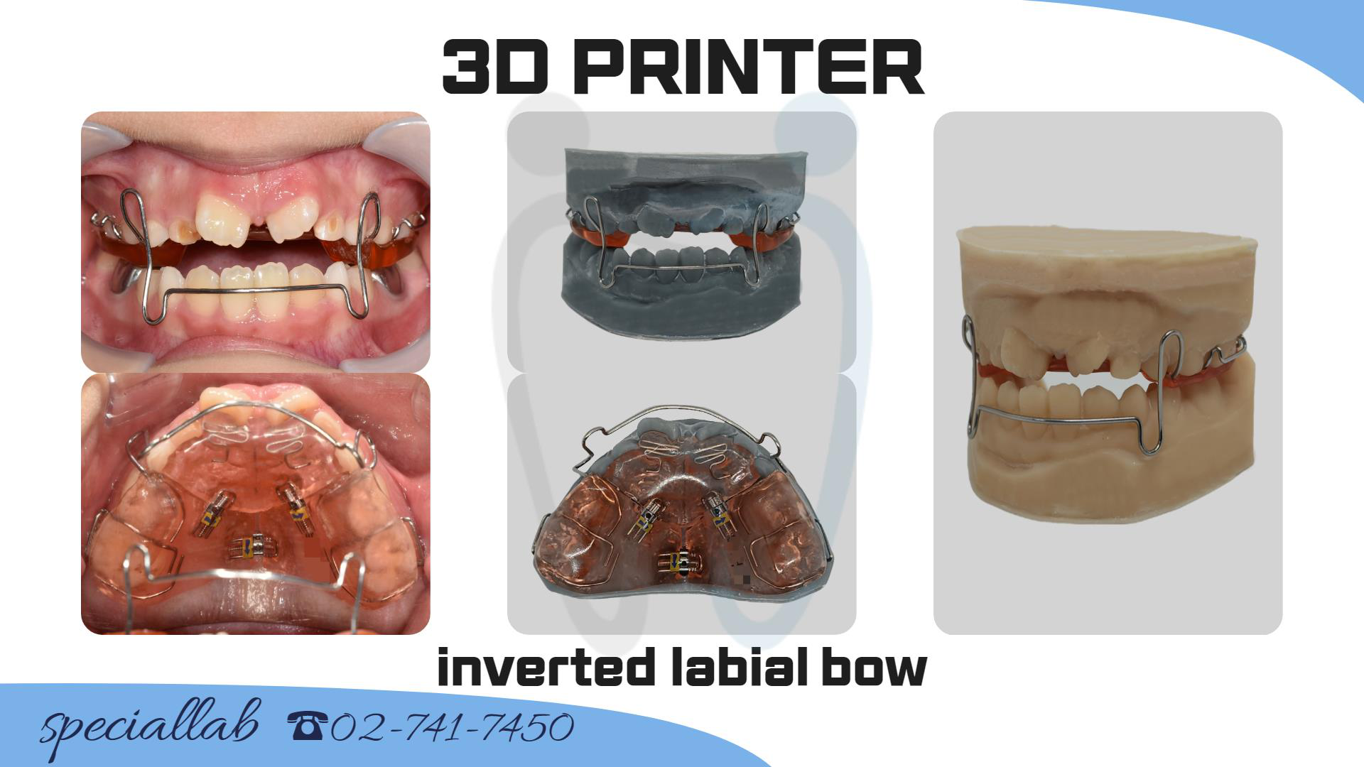 3D CR 스플린트 After